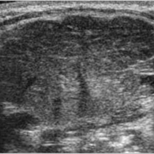 Viêm tuyến nước bọt