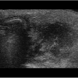 Viêm tuyến nước bọt