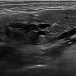 Viêm tuyến nước bọt