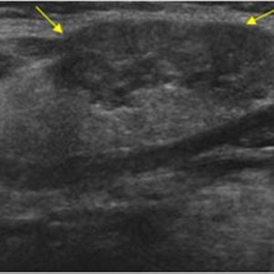 Viêm tuyến nước bọt