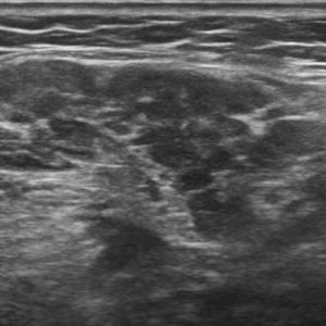 Viêm tuyến nước bọt