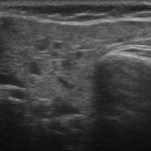 Viêm tuyến nước bọt