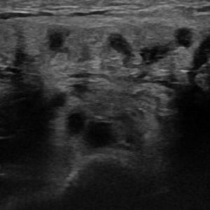 Viêm tuyến nước bọt