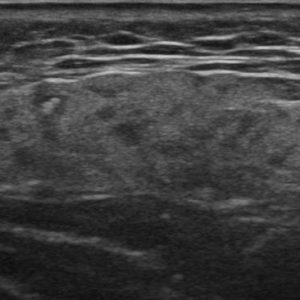 Viêm tuyến nước bọt