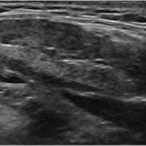 Viêm tuyến nước bọt