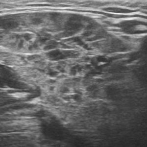 Viêm tuyến nước bọt