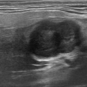 U tuyến nước bọt