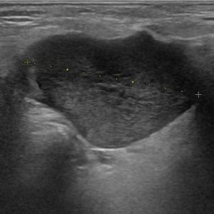 U tuyến nước bọt