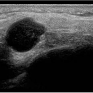 U tuyến nước bọt