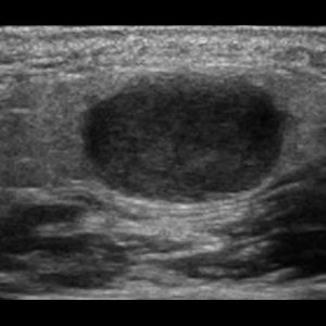 U tuyến nước bọt