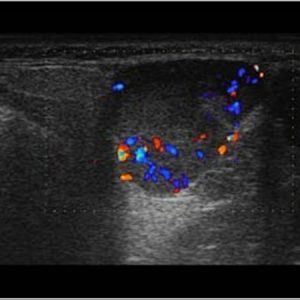 U tuyến nước bọt