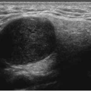 U tuyến nước bọt