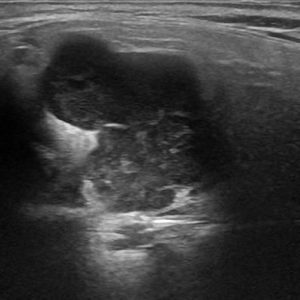 U tuyến nước bọt