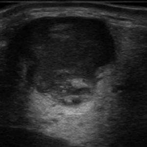 U tuyến nước bọt