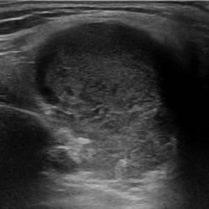 U tuyến nước bọt