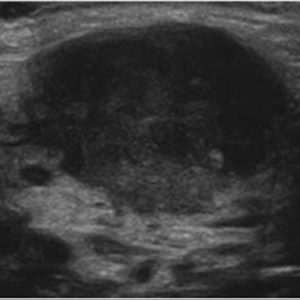 U tuyến nước bọt