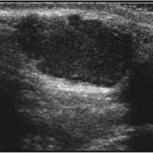 U tuyến nước bọt