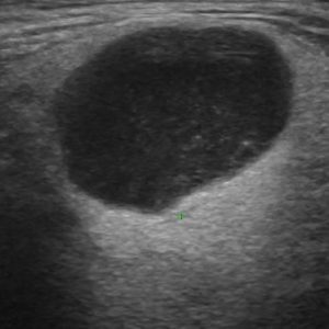 U tuyến nước bọt