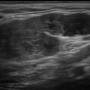 U tuyến nước bọt