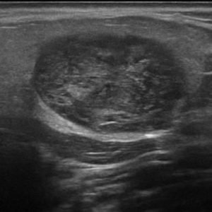 U tuyến nước bọt