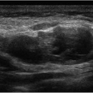 U tuyến nước bọt