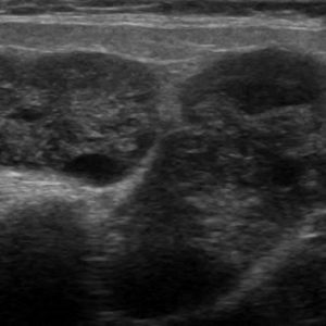 U tuyến nước bọt