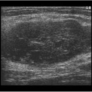 U tuyến nước bọt