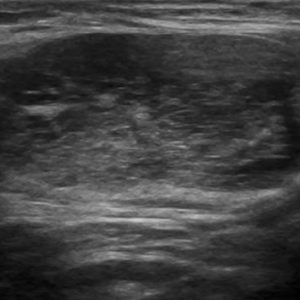 U tuyến nước bọt