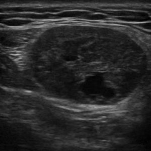 U tuyến nước bọt