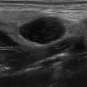 U tuyến nước bọt