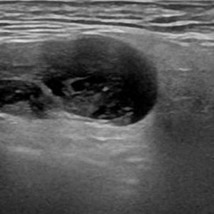 U tuyến nước bọt