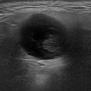 U tuyến nước bọt