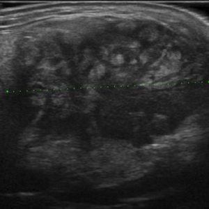 U tuyến nước bọt