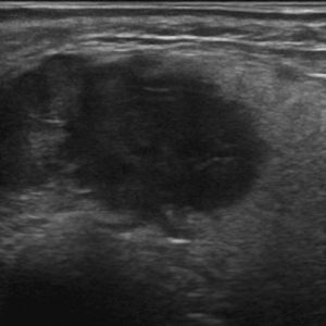 U tuyến nước bọt