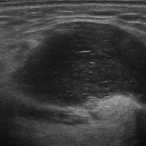 U tuyến nước bọt