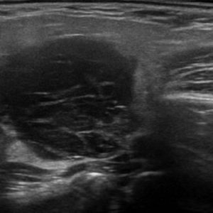 U tuyến nước bọt