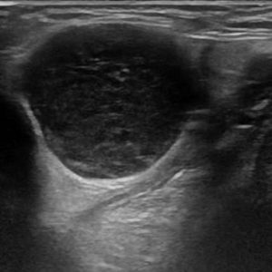 U tuyến nước bọt