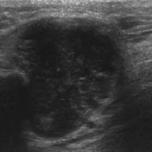 U tuyến nước bọt