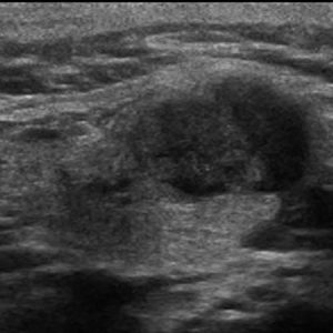 U tuyến nước bọt