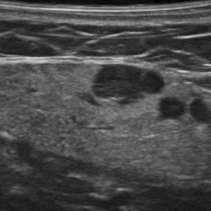 Hạch tuyến nước bọt