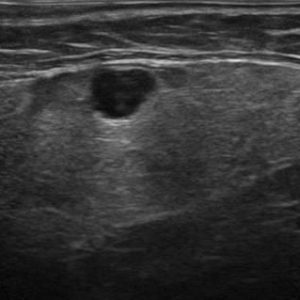 Hạch tuyến nước bọt