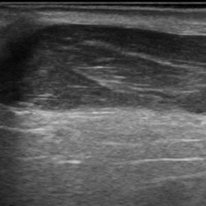 U tuyến nước bọt