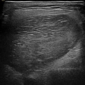 U tuyến nước bọt