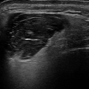 U tuyến nước bọt