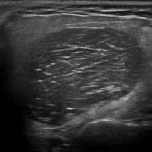 U tuyến nước bọt