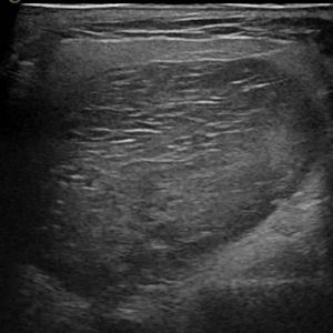 U tuyến nước bọt