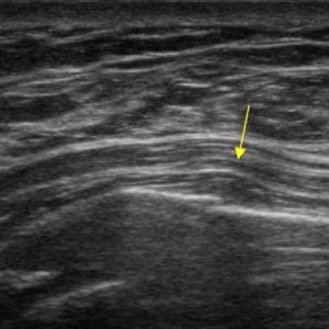 Gãy xương sườn