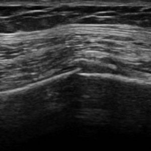 Gãy xương sườn