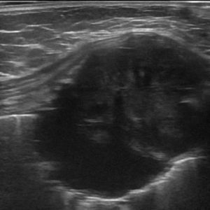 Di căn thành ngực