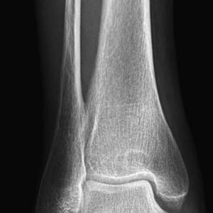 Chấn thương cẳng chân